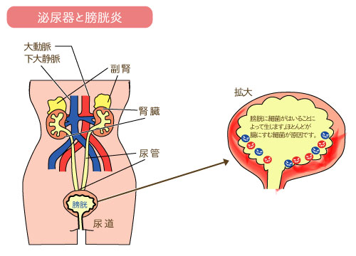 方 膀胱 炎 直し