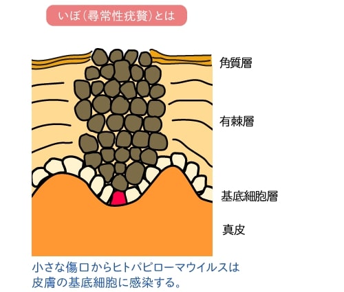 ウイルス性イボ