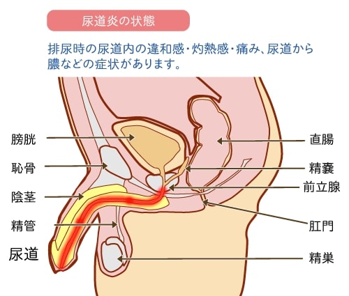 尿道炎