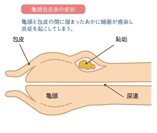 炎 糖尿病 塗り薬 包皮 性 亀頭包皮炎(きとうほうひえん)は市販薬でも治せます【画像あり】