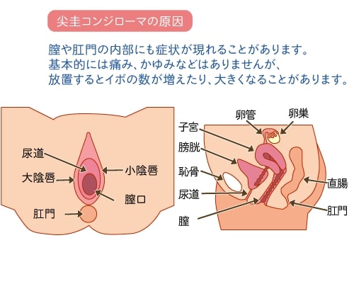 尖 圭 コンジローマ 画像