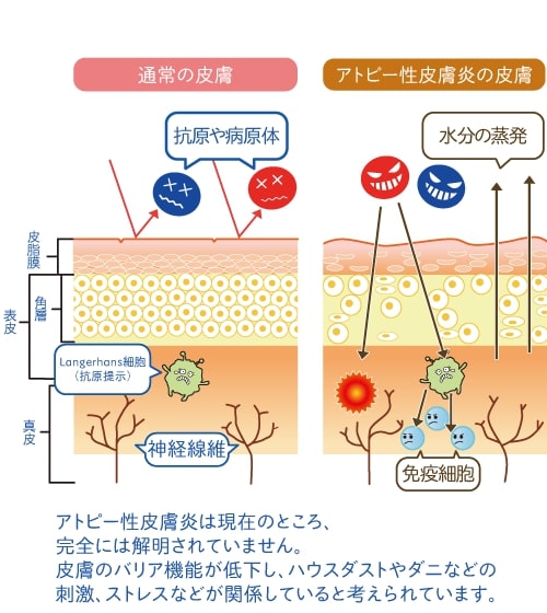 炎 皮膚 アトピー 性 3.アトピー性眼瞼炎